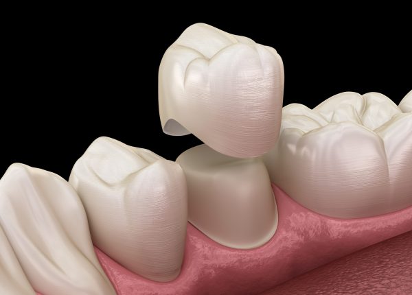 Dental crown premolar tooth assembly process. Medically accurate Dental crown premolar tooth assembly process. Medically accurate 3D illustration of human teeth treatment